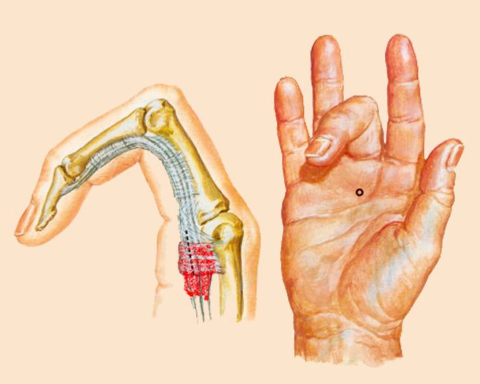Ankylosing Spondylitis Arthritis Treatment in Calicut Kerala